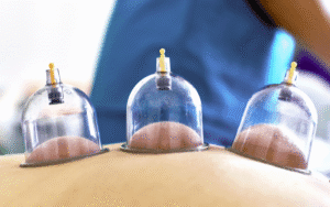 A close-up shot of three cups used for cup therapy in Islam, a traditional healing practice known as Hijama, placed on a person's back.